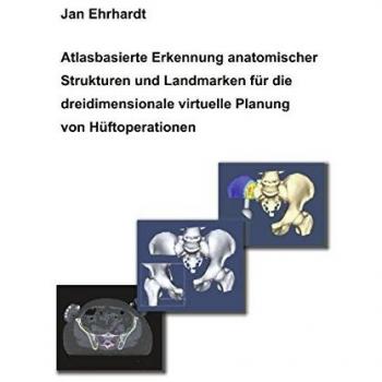 Atlasbasierte Erkennung anatomischer Strukturen und Landmarken für die dreidimensionale virtuelle Planung von Hüftoperationen