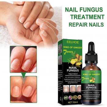 Cura rápida de hongos en uñas de pies