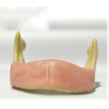 Gingiva douce 7‑Formation Implant Simulation
