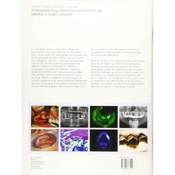 Antiresorptive Drug-Related Osteonecrosis of the Jaw