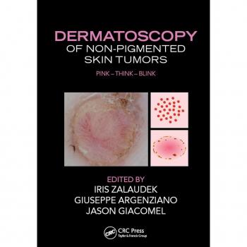 Dermatoscopy of Non-Pigmented Skin Tumors