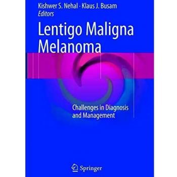 Lentigo Maligna Melanoma