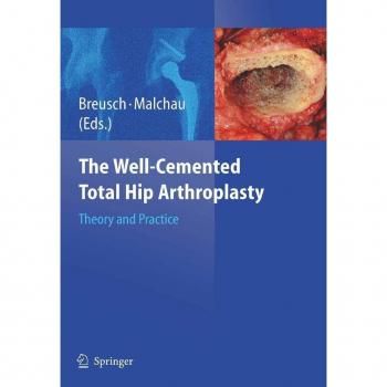 Vitalsource Technologies, Inc. Well-cemented Total Hip Arthroplasty