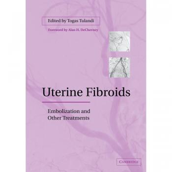 Uterine Fibroids