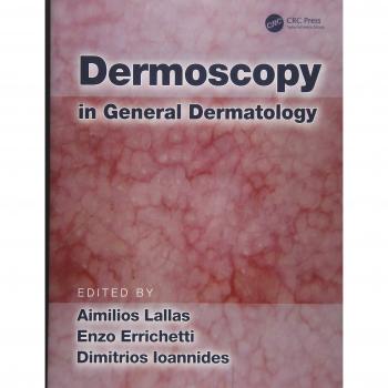 Dermoscopy in General Dermatology