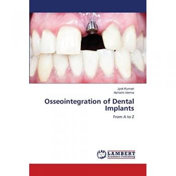 Osseointegration of Dental Implants: From A to Z