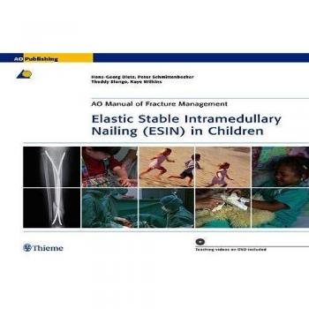 Elastic Stable Intramedullary Nailing