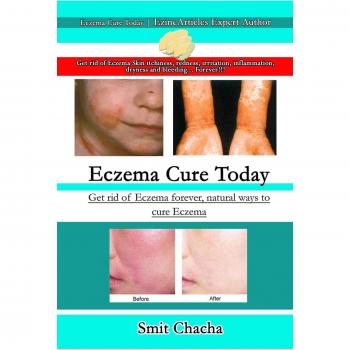 Eczema Cure Today