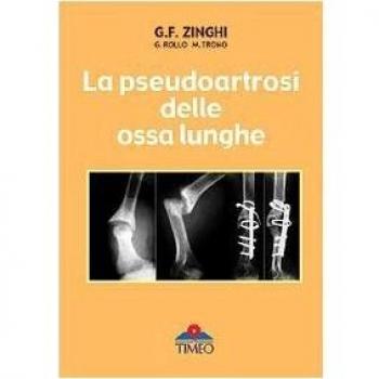 La pseudoartrosi delle ossa lunghe