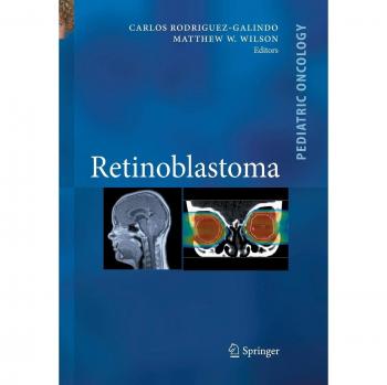Retinoblastoma