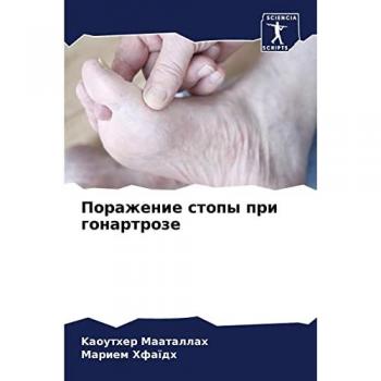 Поражение стопы при гонартрозе