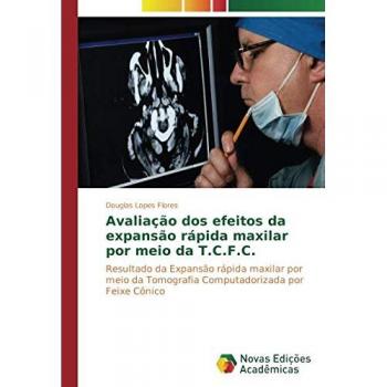 Avaliação dos efeitos da expansão rápida maxilar por meio da T.C.F.C.: Resultado da expansão rápida maxilar por meio da tomografia computadorizada por feixe cônico