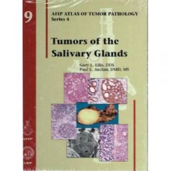 Tumors of the Salivary Glands