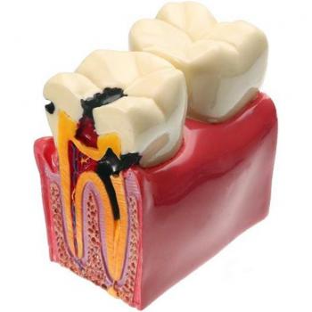 1 pc Dental Materials Lab Teeth Model 6 Times Caries Comparison Study Models For Dentist Studying and Researching