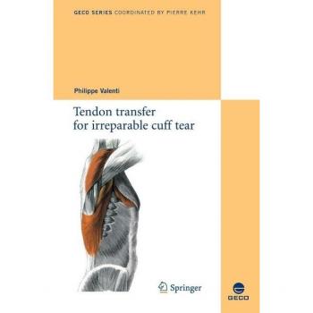 Tendon transfer for irreparable cuff tear