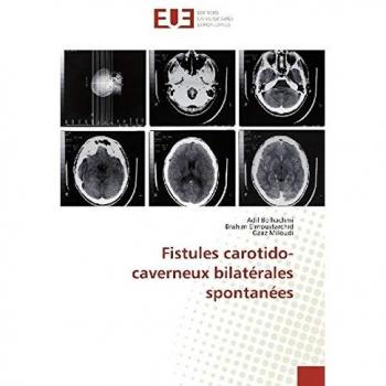 Fistules carotido-caverneux bilatérales spontanées