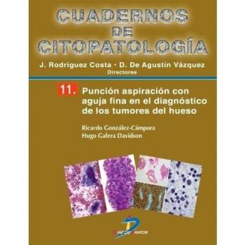 Punción aspiración con aguja fina en el diagnóstico de los tumores de hueso: Cuadernos de citopatologia-11.