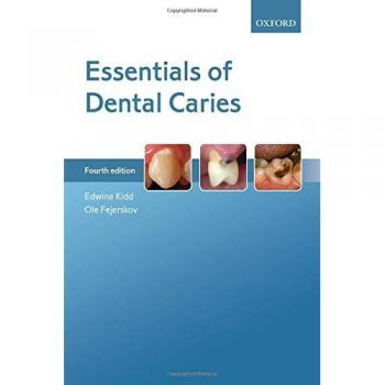 Essentials of Dental Caries