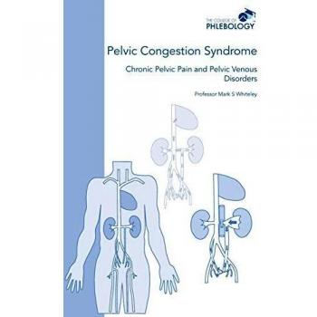 Pelvic Congestion Syndrome