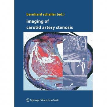 Imaging of Carotid Artery Stenosis